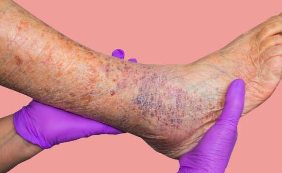 Por que as veias varicosas são perigosas