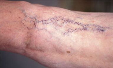 métodos de tratamento de varizes nas pernas