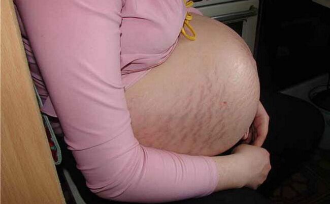 causas de varizes durante a gravidez