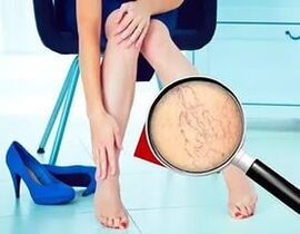 Os sintomas dependem da natureza e do estágio das veias varicosas