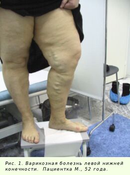 Varizes devem ser tratadas para interromper o processo