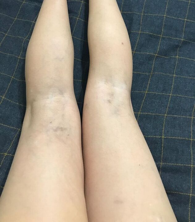 manifestações de varizes nas pernas