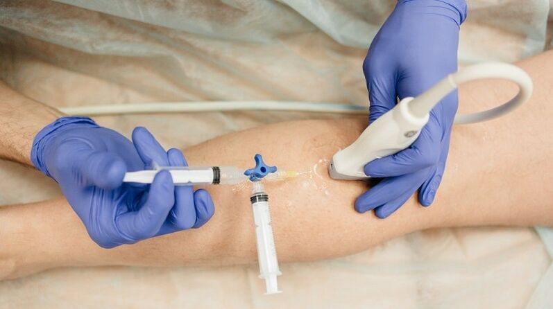 escleroterapia para varizes