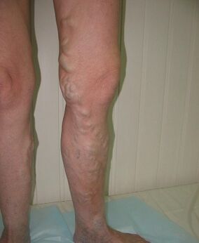 veias salientes na perna devido a veias varicosas